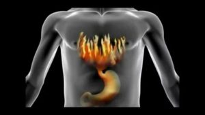 Газы после антибиотиков, горит пищевод, изжога