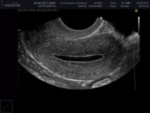 Серозометра при беременности