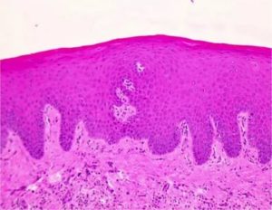 Гиперкератоз вульвы