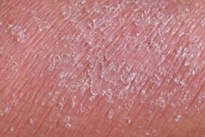 Зуд малых половых губ, покраснение