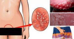 Сильное раздражение у входа во влагалище