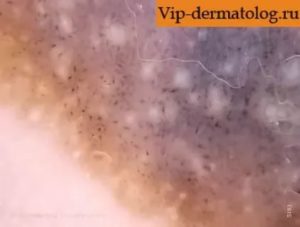 Гиперкератоз вульвы