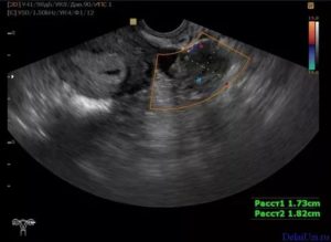 Узи показывет в ячники желтое тело есть ли беременность