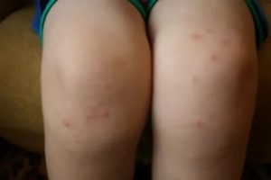 Сыпь на ноге при беременности