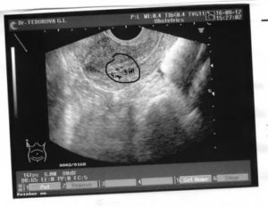 Узи 5 акушерских недель