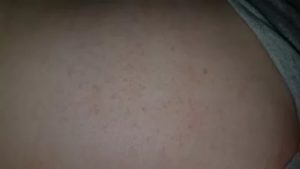Красная сыпь на животе и руках