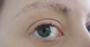 Мадароз (выпадение ресниц)