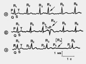 Панические атаки и экстрасистолия