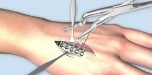 Перелом пятой пястной кости спицы