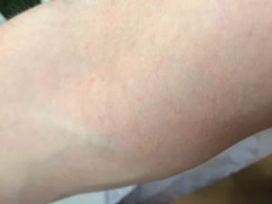 Зуд на внутренней стороне предплечья