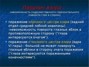 Парез взора