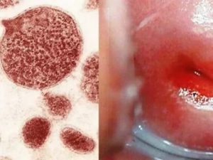 Уреаплазма и простуда