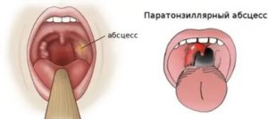 Опухла одна миндалина