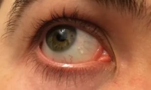 Пузырик в уголке глаза
