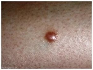 Образование на коже словно запекшая кровь