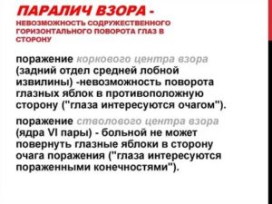Парез взора