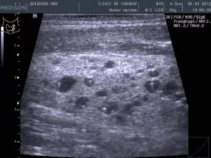 Коллоидные кисты щитовидной железы