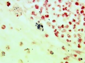 В мазке коккобациллярная флора