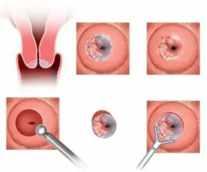 Обильное кровотечение после прижигания эрозии на шейке матки