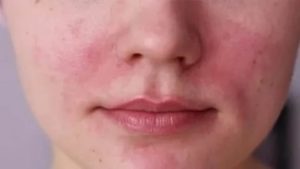 Проблема кожи лица, покраснения, жжения в район щек