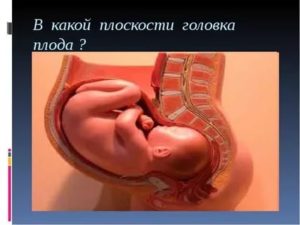 Низкое расположение головки плода
