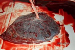 """Рыхлая"" плацента"