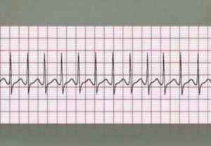 Тахикардия на фоне орви