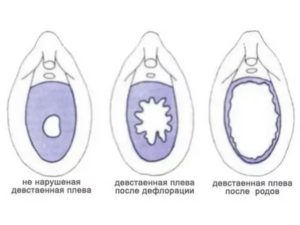 Можно ли травмой повредить девственную плеву?