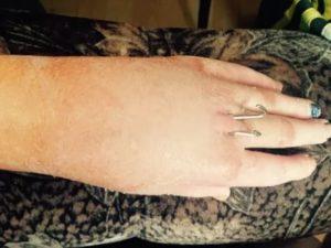 Перелом пятой пястной кости спицы