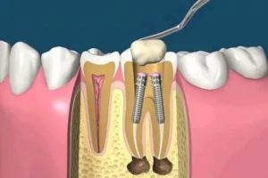 Аллергия на штифты
