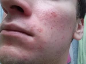Сыпь на правой щеке