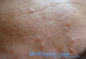 Сальные железы на поверхности полового члена