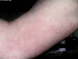 Сыпь на руках и ногах без зуда