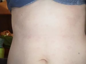 Красная сыпь на животе и руках