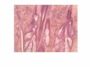 Гиперкератоз вульвы