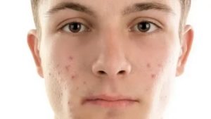 Прыщик на лице