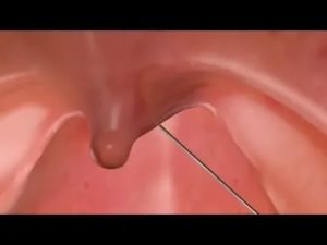 Шарик на задней стенке глотки