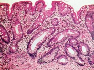 Очаговая метаплазия