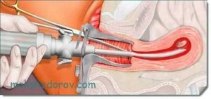 Употребление Регулона после замершей беременности