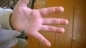 Зимой у дочери облазит кожа на ладошках и пальчиках