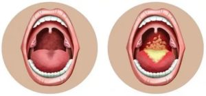 Хламидийный фарингит