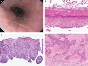 Очаговая метаплазия