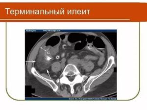 Терминальный илеит