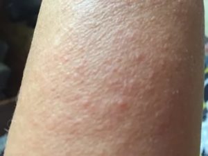 Сыпь на руках и ногах без зуда