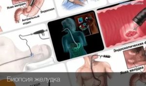 Боль после биопсии желудка