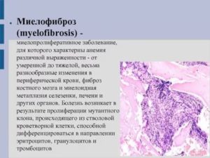 Миелофиброз