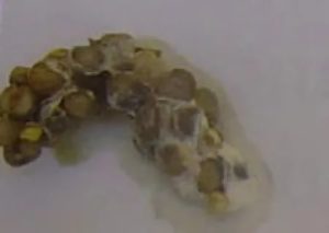 Серые пленки в кале