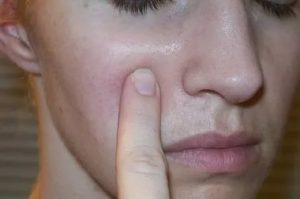 Припухлость возле носа и идёт под глаз после лечения зуба