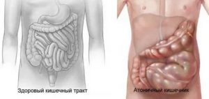 Атония прямой кишки