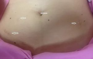 Самостоятельная беременность в первом цикле после лапароскопии